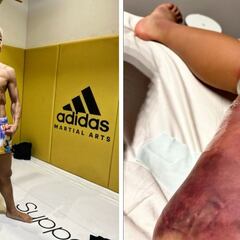 Así quedó la pierna de Takeru Segawa tras un combate de kickboxing