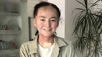 Día de la Piel de Cristal: ¿Cuál es el panorama en Chile?