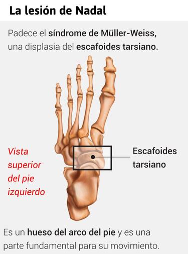 Una carrera a contrapi