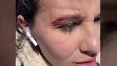 Paola de Jesús con al ceja abierta tras un accidente con un telesilla.