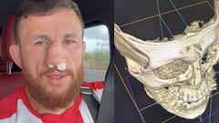 El ‘tercer’ Topuria se rompe la nariz y podría estar un año fuera de la jaula