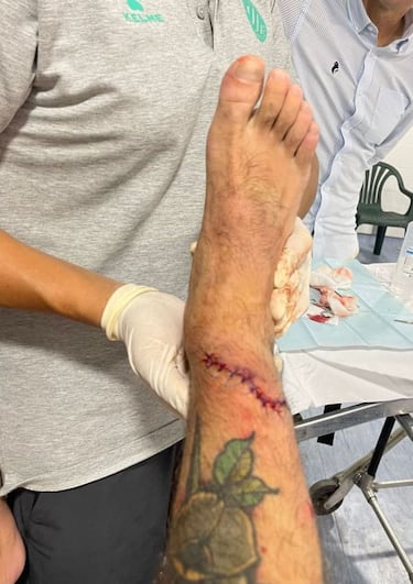 As¨ª est¨¢ la tibia de Aleix Vidal tras su 'miniderbi' con el Betis
