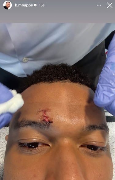 Mbappé, con puntos en la ceja