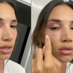 India Martínez preocupa al mostrar su rostro desfigurado: “Ni el móvil me reconoce”