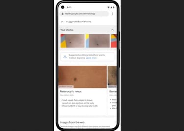 Identificar un cáncer de piel con sólo la cámara del móvil, una herramienta IA de Google