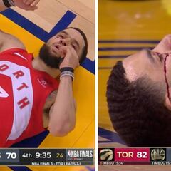 Un diente roto y sangrando por el ojo tras el codazo: la acción más desagradable de las Finales