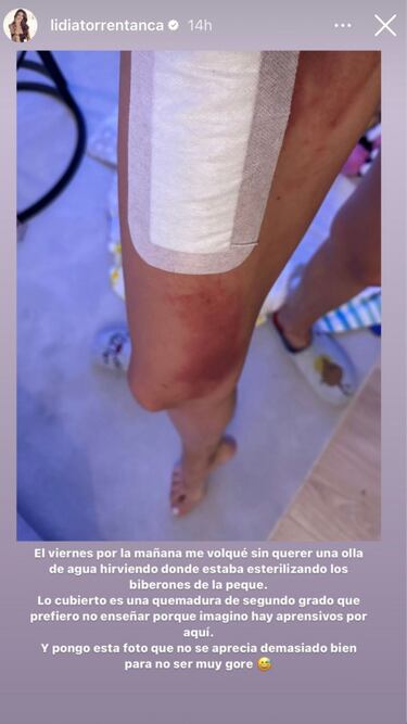 El accidente de Lidia Torrent que le ha provocado quemaduras de segundo grado