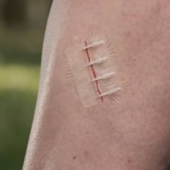 Crean una tirita que cierra heridas abiertas al momento sin necesidad de poner puntos