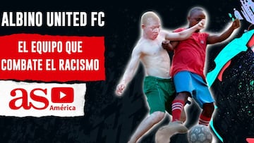 Albino United, un equipo en contra de racismo