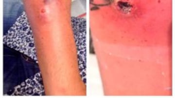 Imagen de las dos picaduras de araña que sufrió Nicolas Roche antes del inicio de temporada 2016.