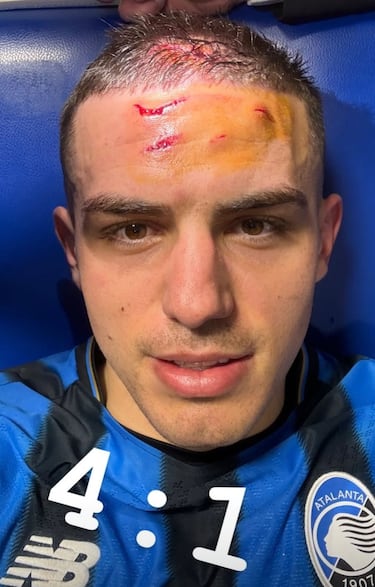 Así quedó el rostro de Nikola Krstović: patada... y a octavos