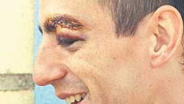 <b>MALA SUERTE. </b>A Zahínos tuvieron que darle seis puntos de sutura.