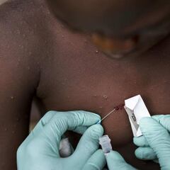 Viruela del mono en México: Salud emite lineamientos para evitar contagios