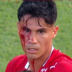 Galdames sufre una brutal patada en Argentina: quedó sangrando y no hubo ni amarilla