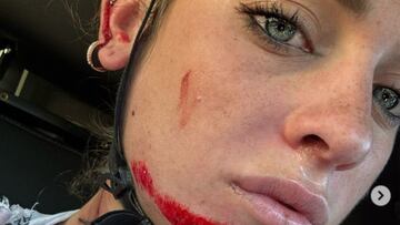 La ciclista italiana Letizia Paternoster muestra sus heridas tras sufrir una caída durante la concentración del AlUla Liv Jayco en España.