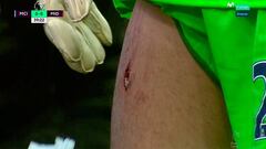 Victor Valdés suffers gruesome gash to the leg via Navas' studs