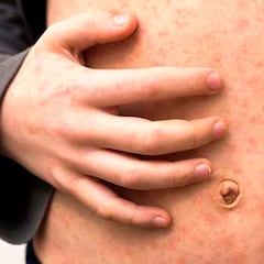 Sarampión en México, hoy: ¿qué estados tienen más contagios y dónde vacunarse?