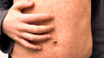 México registra 5 mil 860 casos acumulados de sarampión y Jalisco encabeza la lista de contagios.