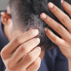 ¿Se te cae el pelo? Cuidado es culpa del efluvio telógeno