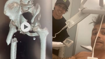 Andreu Lacondeguy en el hospital y radiografía de su fémuer