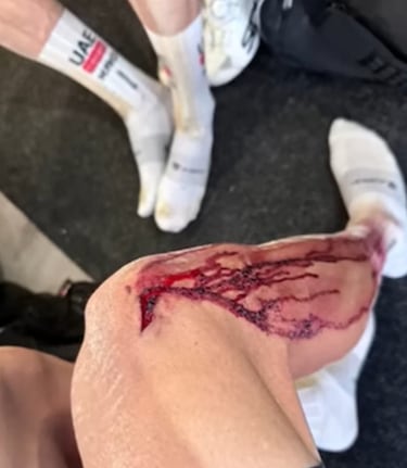 Ayuso recibe siete puntos de sutura tras un corte en la rodilla en el Giro