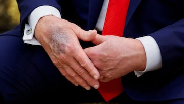 The bruised right hand of U.S. President Donald Trump is visible during a meeting with South Korean President Lee Jae Myung at the Oval Office, at the White House, in Washington, D.C., U.S., August 25, 2025. REUTERS/Brian Snyder TPX IMAGES OF THE DAY