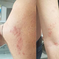 La 'culebrilla' o herpes zóster, otro efecto secundario de la vacuna, sobre todo en Pfizer
