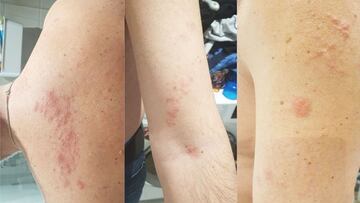 herpes zoster vacuna covid