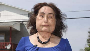 Muere Connie Culp, la mujer que recibi¨® el primer trasplante de cara en Estados Unidos
