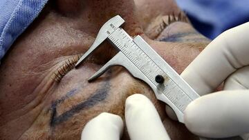 La cirugía de párpados o blefaroplastia es una de las cinco más comunes que se realizan en Colombia, según la Sociedad Internacional de Cirugía Plástica Estética.
(FOTO COLOMBIA.INN/JUAN CARLOS QUINTERO - COLPRENSA)