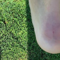 Morata deja imágenes de cómo quedó su talón en Mallorca