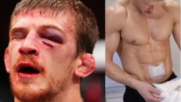 La recuperación express de Arnold Allen: ‘reconstrucción’ de abdomen para volver a la UFC