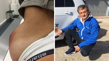 Así le quedó la cadera a Luis Moya tras su accidente de tráfico en Barcelona.
