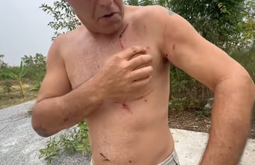 Frank Cuesta muestra sus heridas tras el ataque del ciervo Perrito.