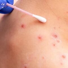 Viruela del mono en México: cuántos nuevos casos hay y cómo evitar contagiarse