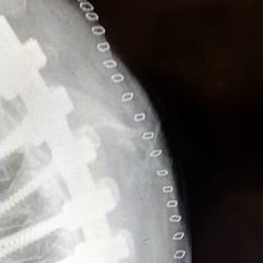 Carrasco muestra los tornillos en su espalda y anuncia novedades