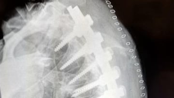 Carrasco muestra los tornillos en su espalda y anuncia novedades