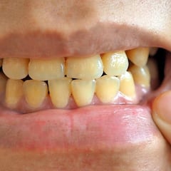 Un dentista desmiente un mito sobre el color amarillo de los dientes: “El blanco natural no existe”