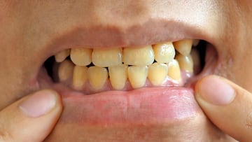 Los científicos terminan con la duda: este es el mejor remedio natural para terminar con el sarro en los dientes