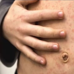 Viruela del Mono en México: Jalisco reporta dos casos positivos, qué se ha dicho