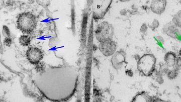 A la izquierda, el tejido de un paciente vivo previamente COVID positivo. A la derecha, el tejido recogido por autopsia de una persona que muri&Atilde;&sup3; de COVID. Las flechas apuntan a las part&Atilde;&shy;culas virales de COVID en ambos espec&Atilde