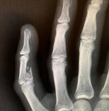 Fredy Guarín jugará con la mano inmovilizada por fractura