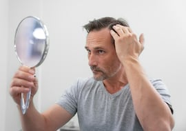 Javier Pedraz, experto capilar: “La alopecia androgénica es la principal indicación para el trasplante, y su causa fundamental es clara: la genética”