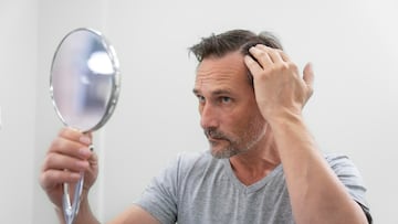 Javier Pedraz, experto capilar: “La alopecia androgénica es la principal indicación para el trasplante, y su causa fundamental es clara: la genética”