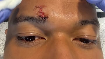 Mbappé, con puntos en la ceja