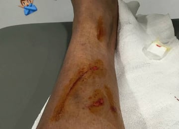 Las marcas de la pierna de Danilo.