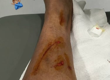 Danilo muestra las heridas del pisotón de David García