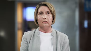 Hito histórico en España: realizado con éxito el primer trasplante de cara del mundo