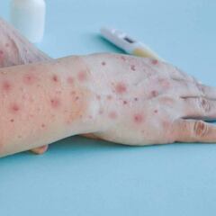 Mpox: ¿cuántos casos de viruela del mono hay en México y dónde se encuentran?