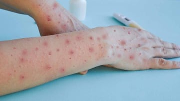 Mpox: ¿cuántos casos de viruela del mono hay en México y dónde se encuentran?